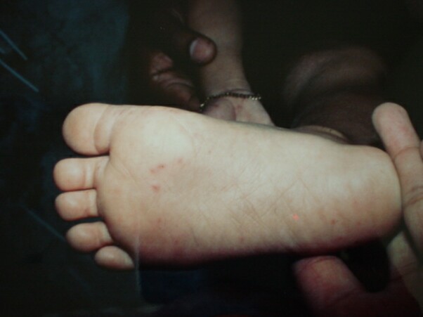 足の発疹の様子