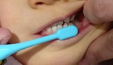 奥歯の外側