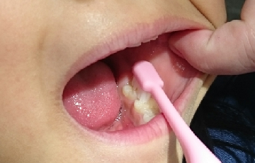 奥歯の溝