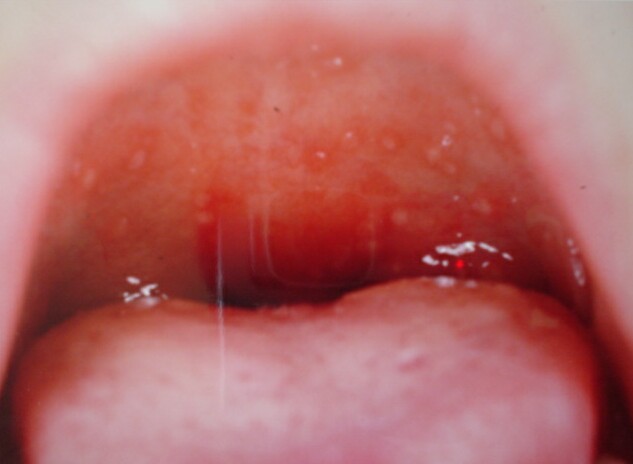 口の中の発疹の様子