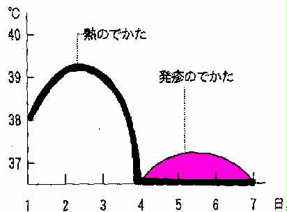 熱・発疹のでかたのグラフ