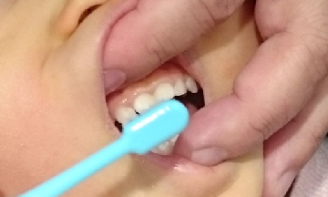 前歯の表側