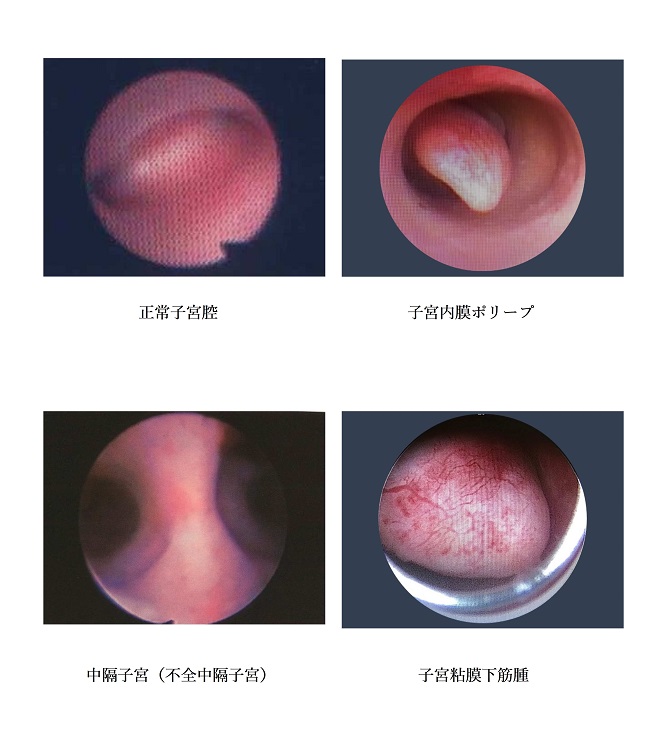 子宮鏡画像