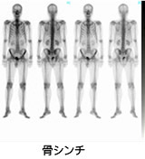 骨シンチグラム