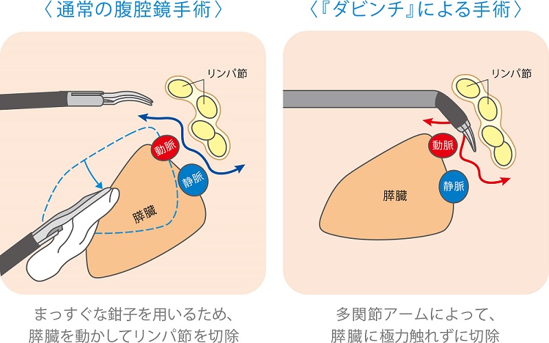 ロボット手術センター手術画像（膵上縁リンパ節郭清）