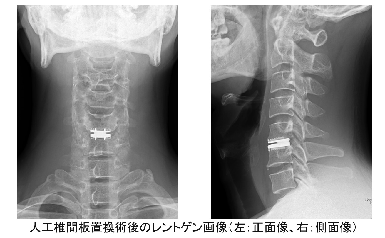 人工椎間板置換術後のレントゲン画像(左:正面像、右:側面像)