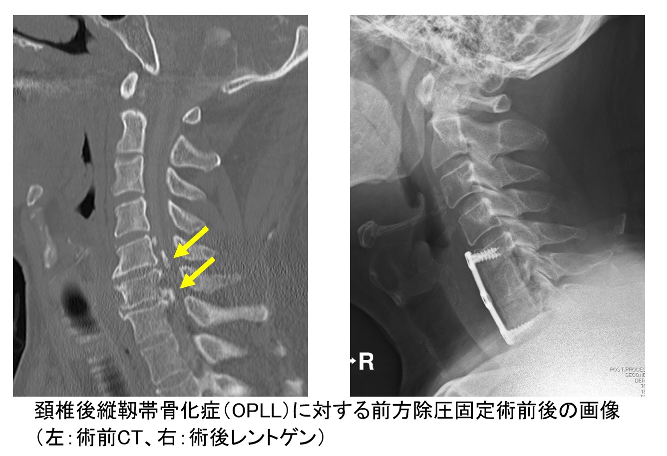 頚椎後縦靭帯骨化症に対する前方除圧固定術前後の画像（左：術前CT、右：術後レントゲン）