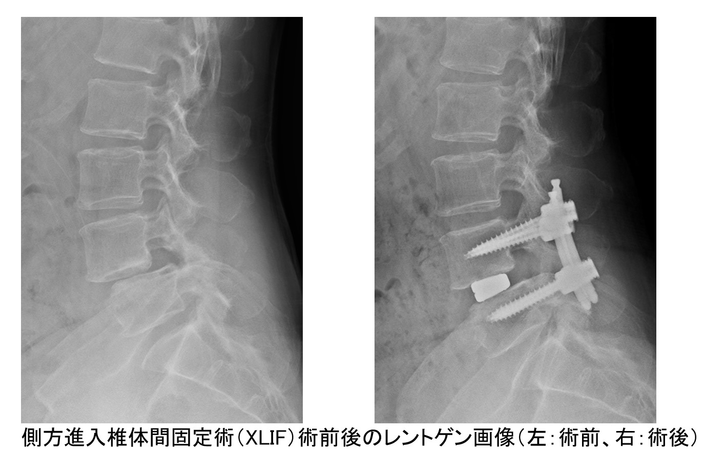 側方進入椎体間固定術の術前後のレントゲン画像（左：術前、右：術後）