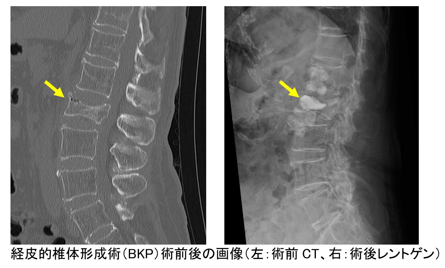 経皮的椎体形成術の術前後の画像（左：術前CT、右：術後レントゲン）