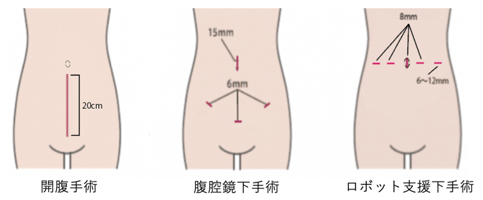 開腹手術、腹腔鏡下手術、ロボット支援下手術のきずの比較イラスト