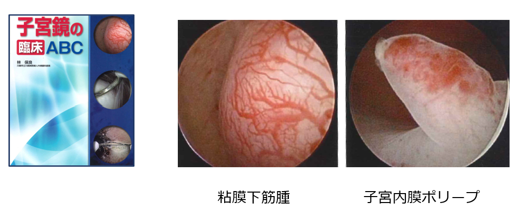 子宮鏡の臨床ABCの冊子、粘膜下筋腫、子宮内膜ポリープの各写真