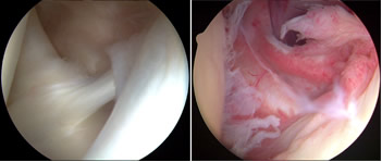 肩関節鏡の比較写真