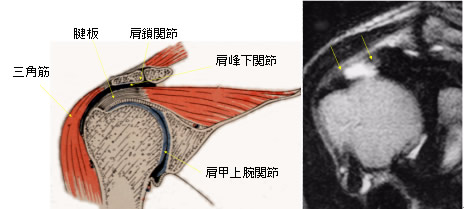 腱板断裂の写真