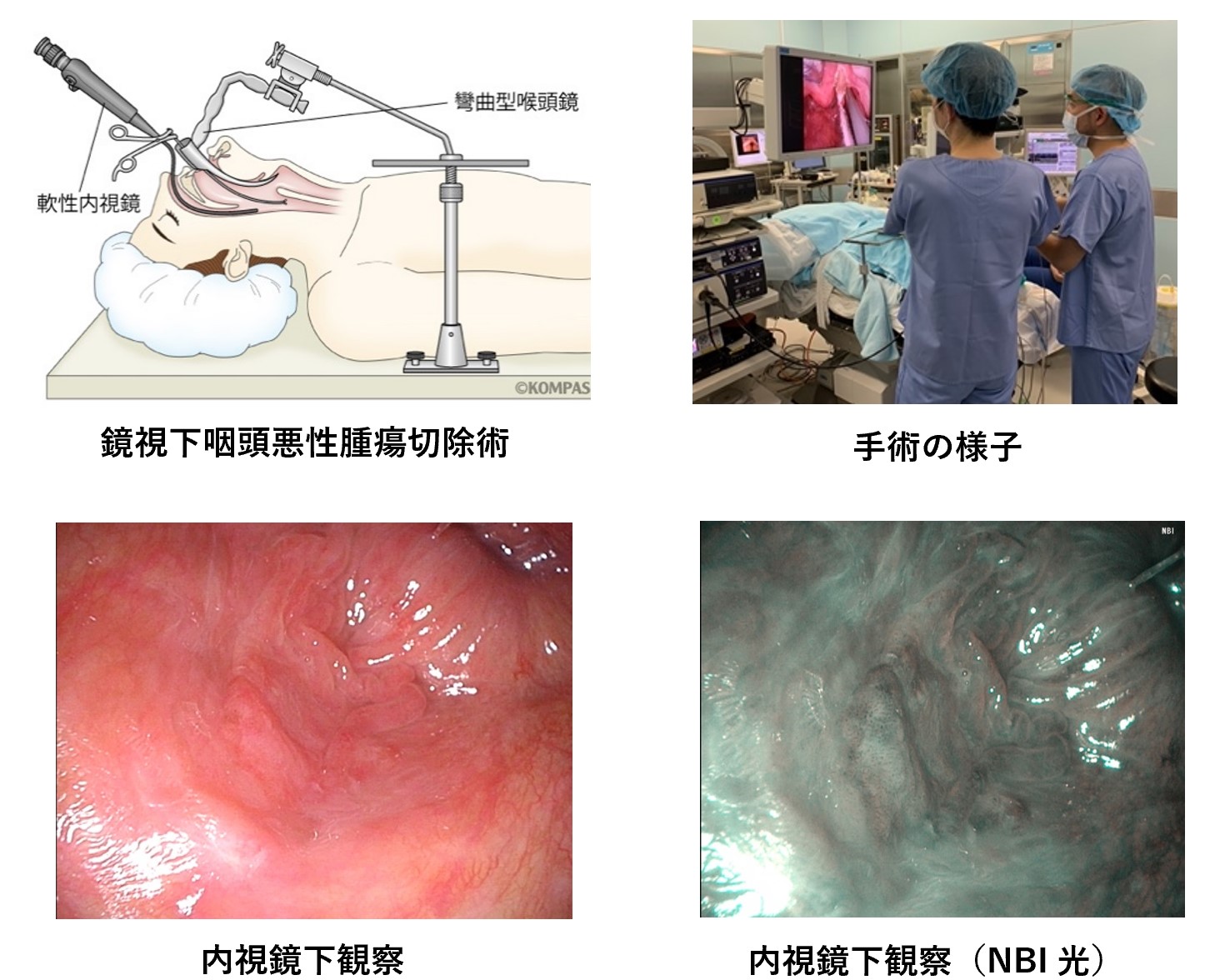 鏡視下咽頭悪性腫瘍切除術のイラスト、手術の様子・内視鏡下観察・内視鏡下観察(NBI光)の各写真
