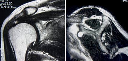 修復可能な腱板断裂の写真