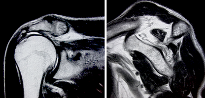 修復不能な場合の腱板断裂の写真