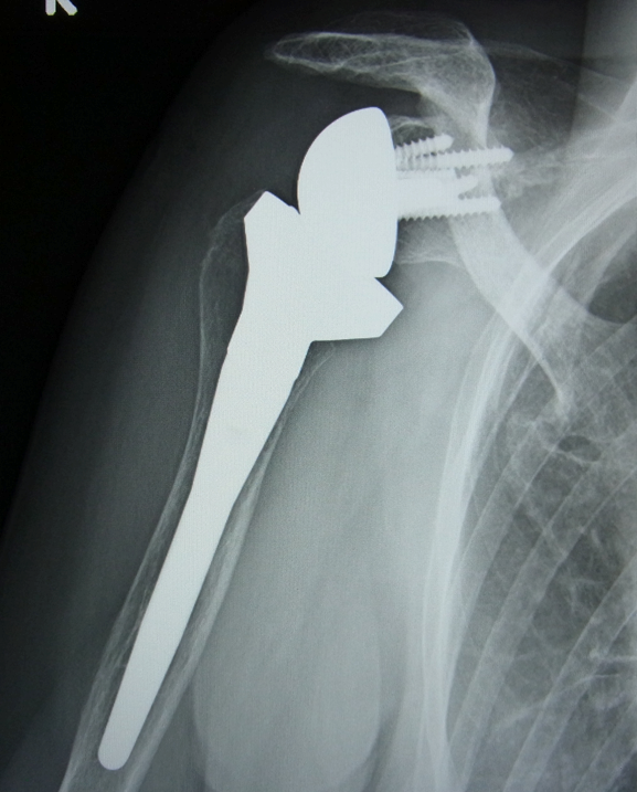 リバース型人工関節のレントゲン写真