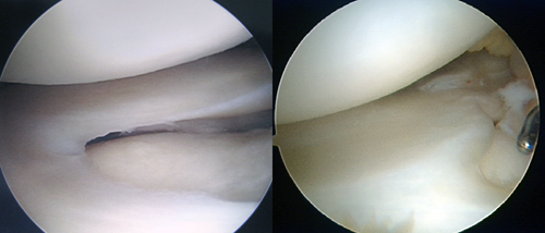 円盤状半月板の比較写真