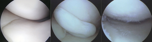 半月板治療の比較写真