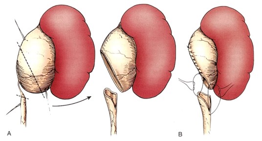腹腔鏡下腎盂形成術の流れの図