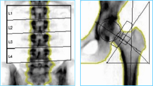 腰椎と大腿骨頸部(股関節)の骨密度の計測画像