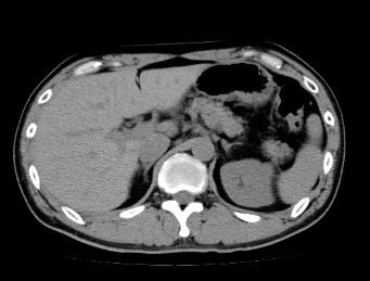 単純検査のCT画像