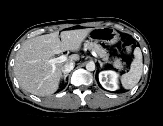 造影検査のCT画像
