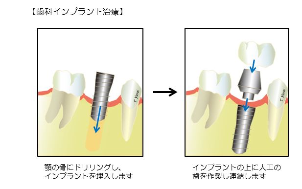 歯科インプラント治療の画像