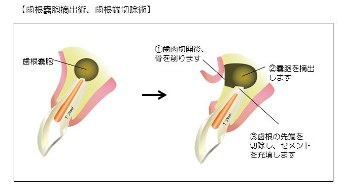 歯根嚢胞摘出術、歯根端切除術の画像