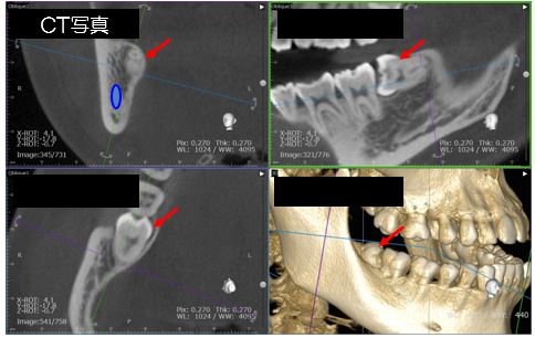 親知らずのCT写真