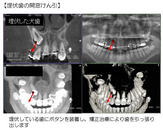 埋伏歯の開窓けん引の写真