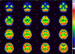 脳血流シンチグラフィの画像