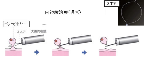 内視鏡治療(通常)