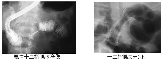 悪性十二市指狭窄像、十二指腸ステント