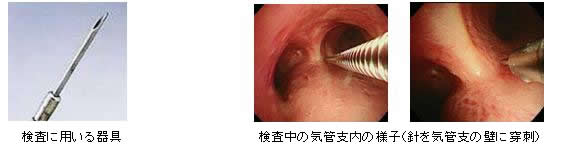 検査に用いる器具/検査中のレントゲン/検査中の気管支内の様子2